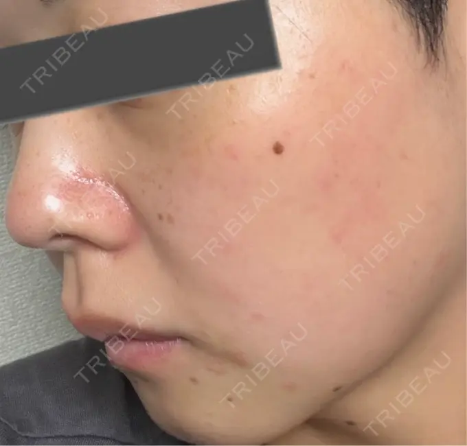 イオン導入 / ピーリング（ハリ・ツヤ） / ルメッカ ルラ美容クリニック 仙台院 / ルラスキンクリニック 仙台院 DAY 1 メイン用