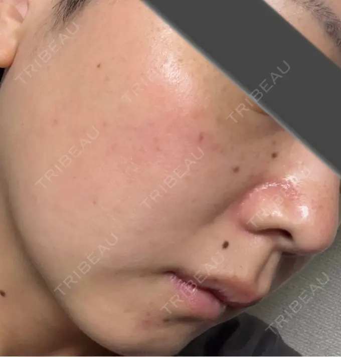 イオン導入 / ピーリング（ハリ・ツヤ） / ルメッカ ルラ美容クリニック 仙台院 / ルラスキンクリニック 仙台院 DAY 1 メイン用