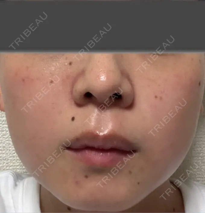 イオン導入 / ピーリング（ハリ・ツヤ） / ルメッカ ルラ美容クリニック 仙台院 / ルラスキンクリニック 仙台院 DAY 2 メイン用