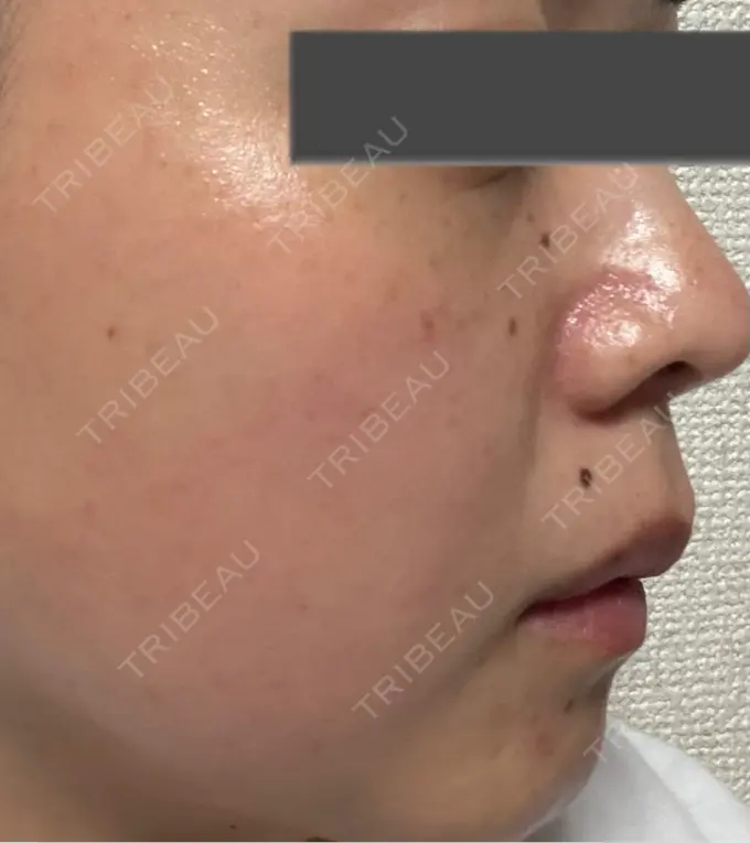 イオン導入 / ピーリング（ハリ・ツヤ） / ルメッカ ルラ美容クリニック 仙台院 / ルラスキンクリニック 仙台院 DAY 2 メイン用