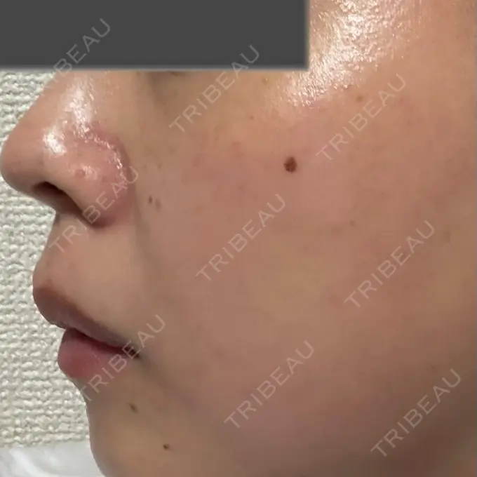 イオン導入 / ピーリング（ハリ・ツヤ） / ルメッカ ルラ美容クリニック 仙台院 / ルラスキンクリニック 仙台院 DAY 2 メイン用