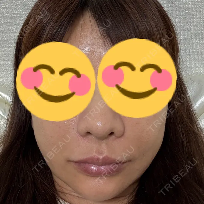 ピーリング（ハリ・ツヤ） Sea Sail Beauty Clinic AFTER メイン用