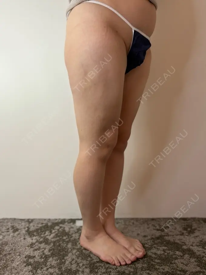 脂肪吸引（顔） / 脂肪吸引（脚） / 脂肪吸引（お尻） GAYA body design clinic DAY 88 メイン用