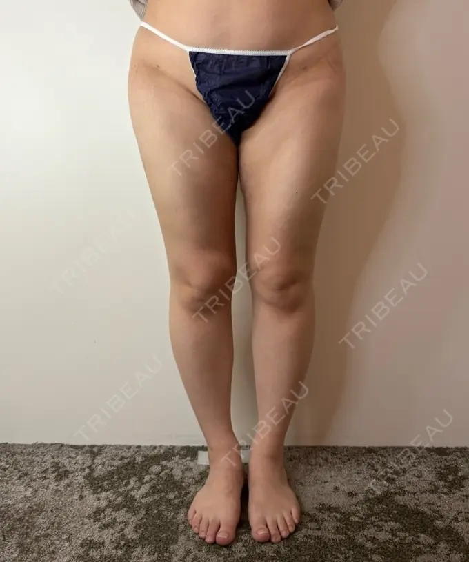 脂肪吸引（顔） / 脂肪吸引（脚） / 脂肪吸引（お尻） GAYA body design clinic AFTER メイン用