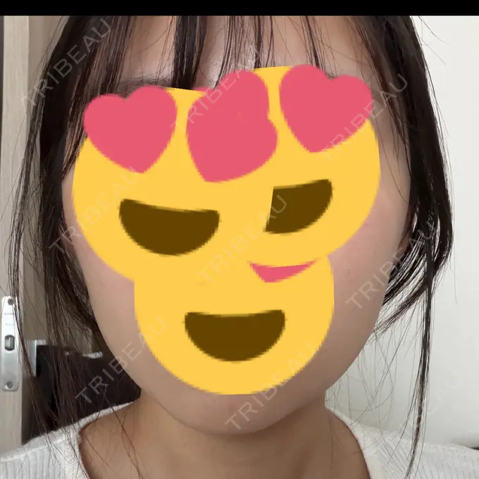 ボトックス（エラ・小顔） 湘南美容クリニック 大阪四ツ橋院 AFTER メイン用