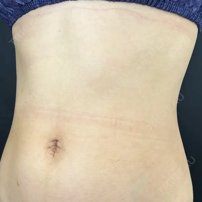 へそ形成 藤・ナチュレ美容クリニック 銀座院 DAY 39 メイン用