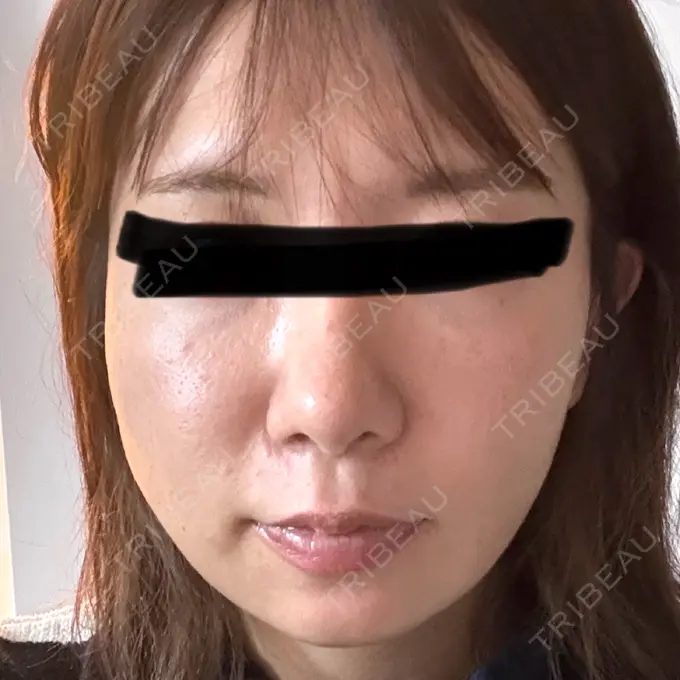 糸リフト / クマ治療 / 脂肪吸引（顔） / ヒアルロン酸注入（涙袋） / ヒアルロン酸注入（唇） ネビュラクリニック 東京錦糸町院 DAY 30 メイン用