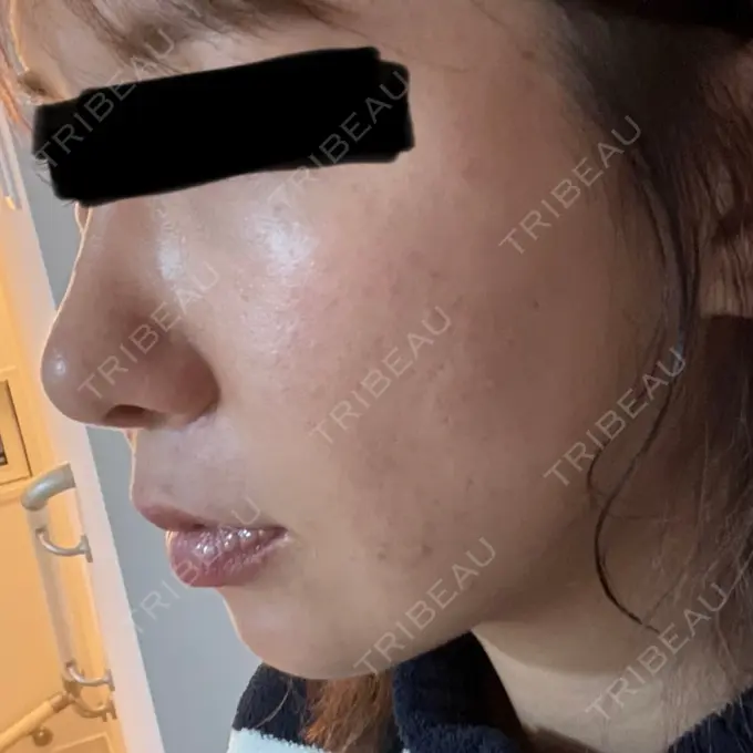 糸リフト / クマ治療 / 脂肪吸引（顔） / ヒアルロン酸注入（涙袋） / ヒアルロン酸注入（唇） ネビュラクリニック 東京錦糸町院 DAY 30 メイン用