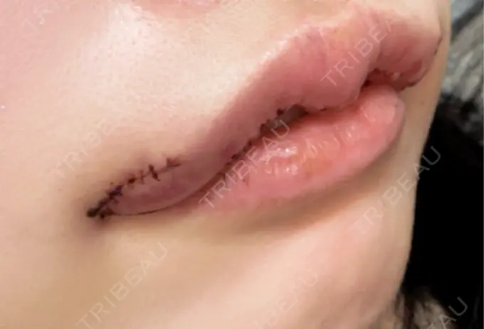 口唇縮小術 / 口角挙上 PRISM Beauty Clinic 町田院 DAY 1 メイン用