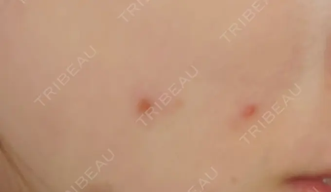 ほくろ・いぼ切除（肌） 札幌中央クリニック DAY 2 メイン用