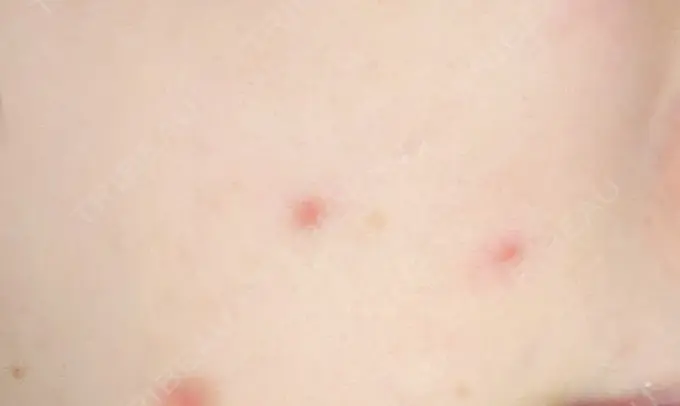 ほくろ・いぼ切除（肌） 札幌中央クリニック DAY 7 メイン用