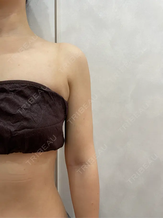 インディバ（肩） / インディバ（二の腕） WOM SALON【術後ケア取扱いサロン】 DAY 0 メイン用