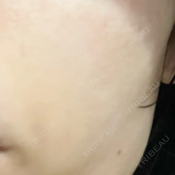 光治療（フォトフェイシャルなど） 銀座TSUBAKIクリニック DAY 0 メイン用