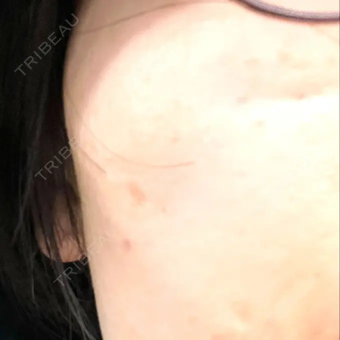 光治療（フォトフェイシャルなど） 銀座TSUBAKIクリニック DAY 0 メイン用