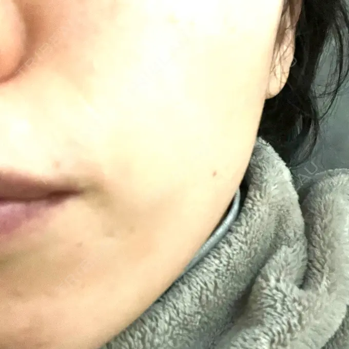 光治療（フォトフェイシャルなど） 銀座TSUBAKIクリニック DAY 1 メイン用