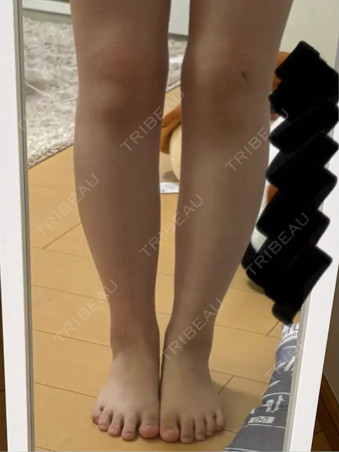 脂肪吸引（脚） / ボトックス（ふくらはぎ） Mods Clinic（モッズクリニック） 名古屋院 DAY 21 メイン用