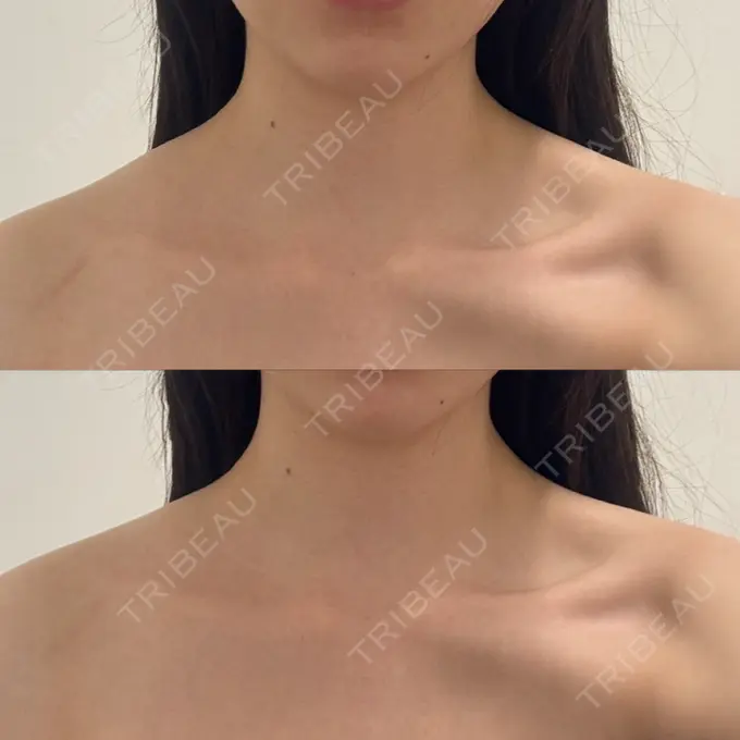 ボトックス（エラ・小顔） DMTC CLINIC 日本橋院 AFTER メイン用