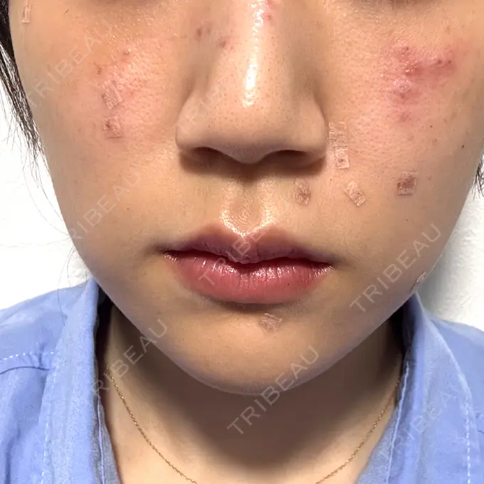 ほくろ・いぼ除去レーザー（肌） / シミ取りレーザー 東京シルククリニック 新宿院 DAY 0 メイン用