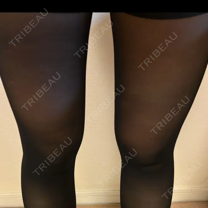 脂肪吸引（脚） / 脂肪吸引（お尻） 湘南美容クリニック 名古屋駅本院 DAY 24 メイン用