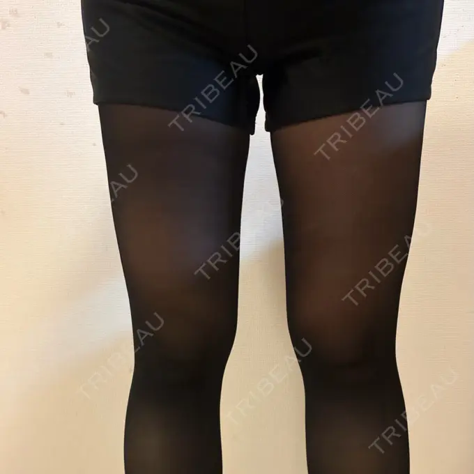 脂肪吸引（脚） / 脂肪吸引（お尻） 湘南美容クリニック 名古屋駅本院 DAY 25 メイン用