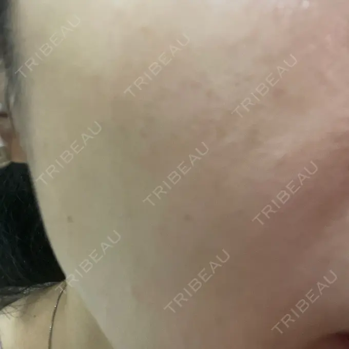 ほくろ・いぼ切除（肌） / 脂肪溶解注射（顔） 吉祥寺アイビークリニック AFTER メイン用