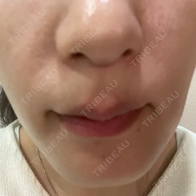 ほくろ・いぼ切除（肌） / 脂肪溶解注射（顔） 吉祥寺アイビークリニック DAY 39 メイン用