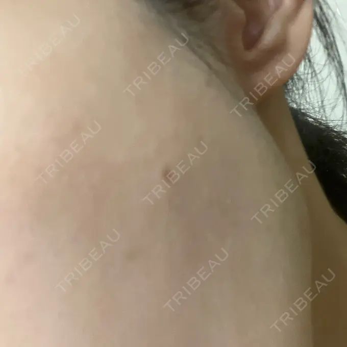 ほくろ・いぼ切除（肌） / 脂肪溶解注射（顔） 吉祥寺アイビークリニック DAY 39 メイン用