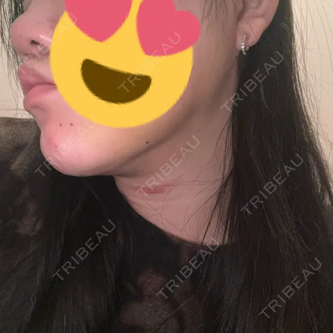 糸リフト / バッカルファット除去 / 脂肪吸引（顔） / ボトックス（エラ・小顔） アリエル美容クリニック 横浜院 AFTER メイン用