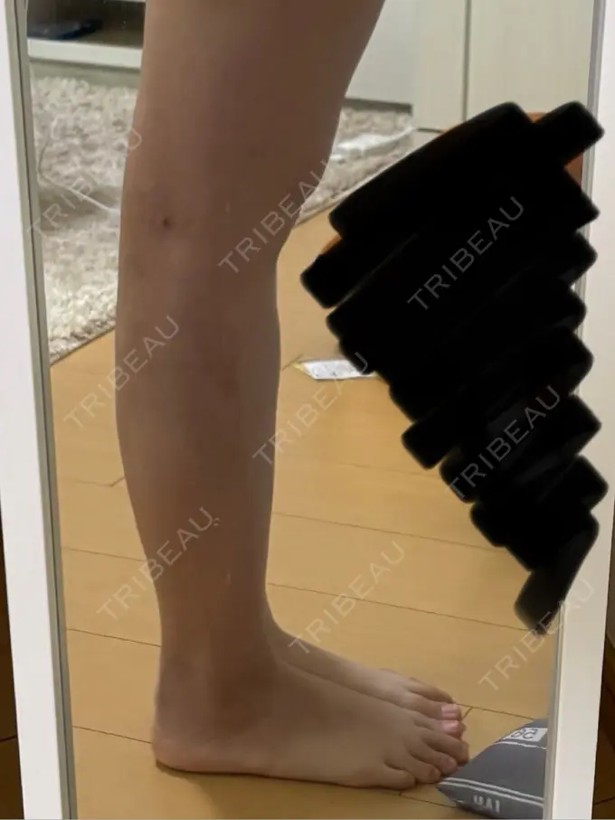 脂肪吸引（脚） / ボトックス（ふくらはぎ） Mods Clinic（モッズクリニック） 名古屋院 DAY 21 メイン用