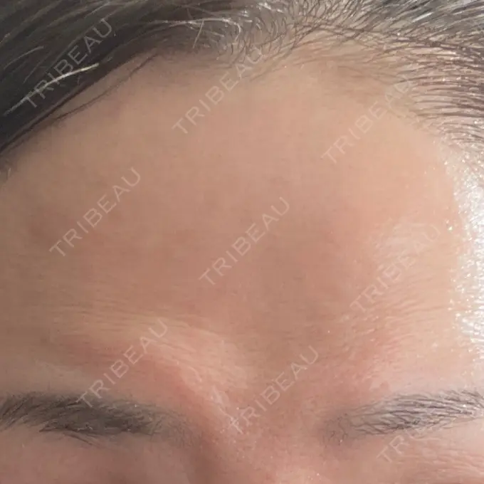 ボトックス（エラ・小顔） / マイクロボトックス ルラ美容クリニック 岐阜院 AFTER メイン用