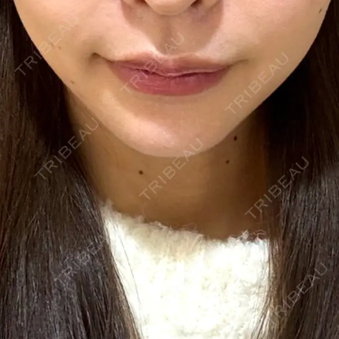 ヒアルロン酸注入（涙袋） / ヒアルロン酸注入（あご） / ヒアルロン酸注入（唇） EMMO FACE CLINIC 東京三田院 AFTER メイン用