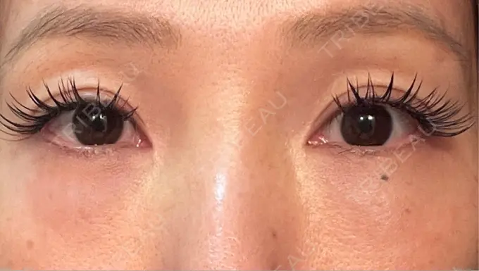 クマ治療 / 下まぶたの脂肪取り ライブリークリニック 浜松町院 DAY 1 メイン用