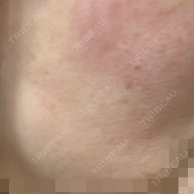 美肌レーザー / 美白レーザー / レーザートーニング（美白・肝斑） 銀座みゆき通り美容外科 大阪梅田院 AFTER メイン用