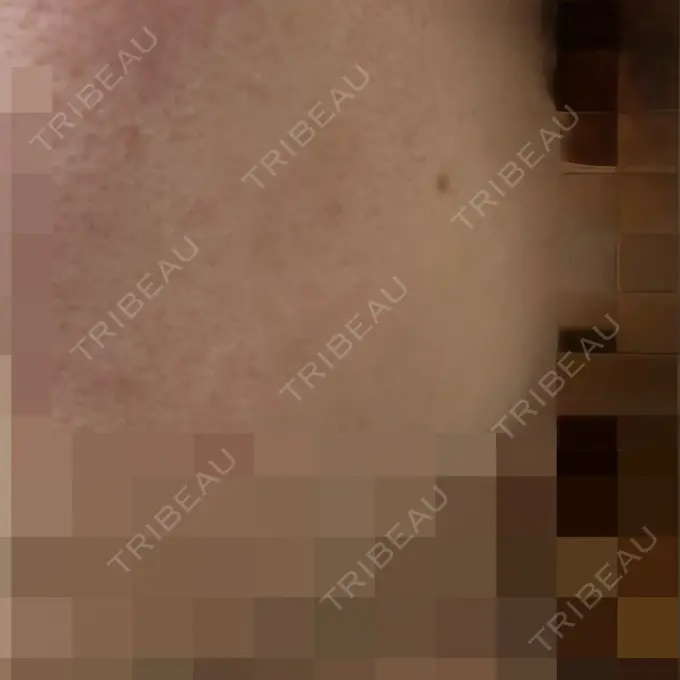 美肌レーザー / 美白レーザー / レーザートーニング（美白・肝斑） 銀座みゆき通り美容外科 大阪梅田院 DAY 4 メイン用