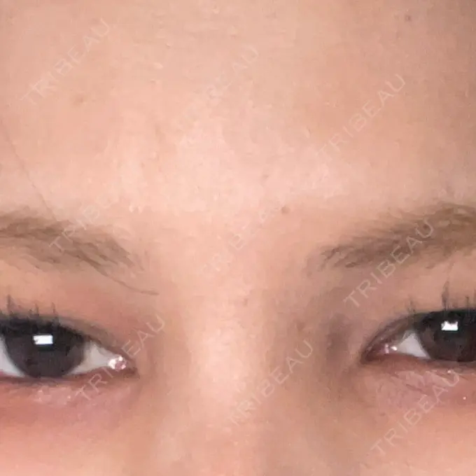 ボトックス（あご） / ボトックス（口角） / ボトックス（タレ目） / ボトックス（眉間） / ボトックス（ガミースマイル） 神戸スイミー皮膚科美容外科 DAY 19 メイン用