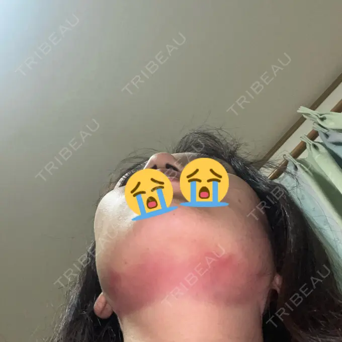 糸リフト / 脂肪吸引（顔） / ジョールファット除去 / ボトックス（エラ・小顔） RIVER CLINIC（リバークリニック） DAY 0 メイン用