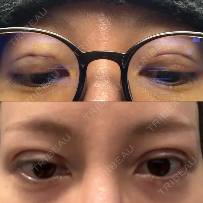 二重埋没 湘南美容クリニック 博多院 DAY 0 メイン用