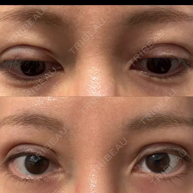 二重埋没 湘南美容クリニック 博多院 DAY 1 メイン用