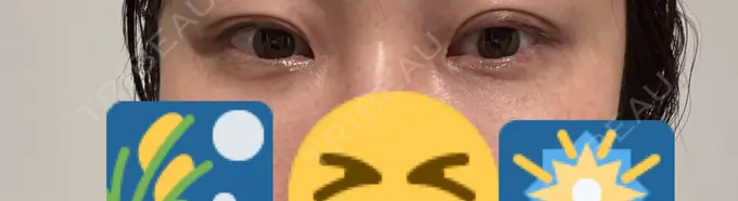 ボトックス（目尻） 札幌TAクリニック DAY 12 メイン用