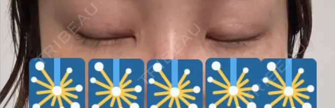 ボトックス（目尻） 札幌TAクリニック DAY 12 メイン用