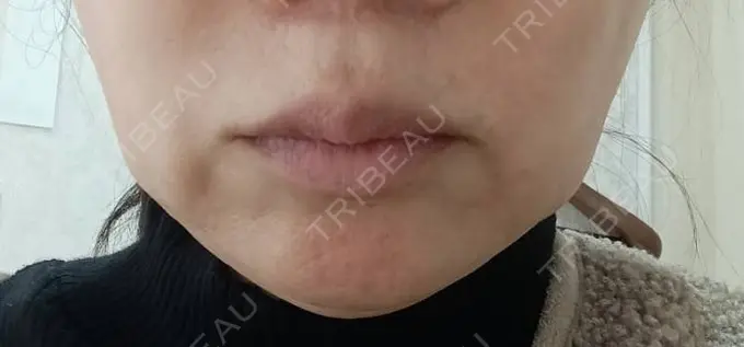 肌ヒアルロン酸注入（たるみ・シワ改善） / ヒアルロン酸注入（唇） AZ BEAUTY CLINIC DAY 19 メイン用