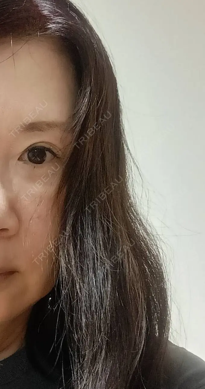 肌ヒアルロン酸注入（たるみ・シワ改善） / ヒアルロン酸注入（唇） AZ BEAUTY CLINIC DAY 19 メイン用