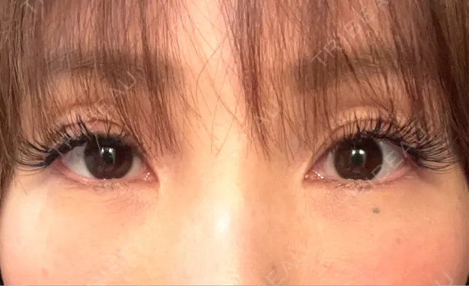 クマ治療 / 下まぶたの脂肪取り ライブリークリニック 浜松町院 AFTER メイン用