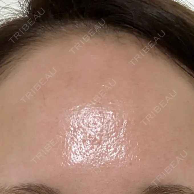 美肌レーザー / 美白レーザー / YAGレーザー / レーザーフェイシャル / 赤み除去レーザー AI Beauty Clinic （エーアイ美容クリニック） DAY 0 メイン用