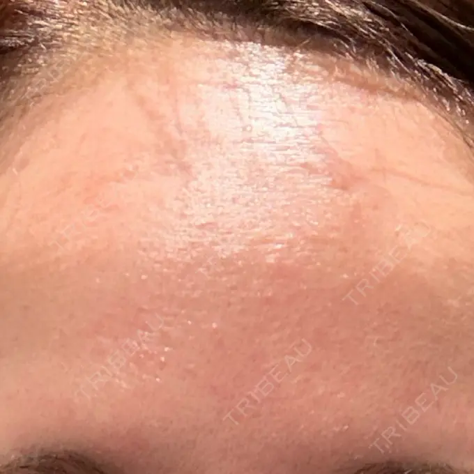 美肌レーザー / 美白レーザー / YAGレーザー / レーザーフェイシャル / 赤み除去レーザー AI Beauty Clinic （エーアイ美容クリニック） AFTER メイン用