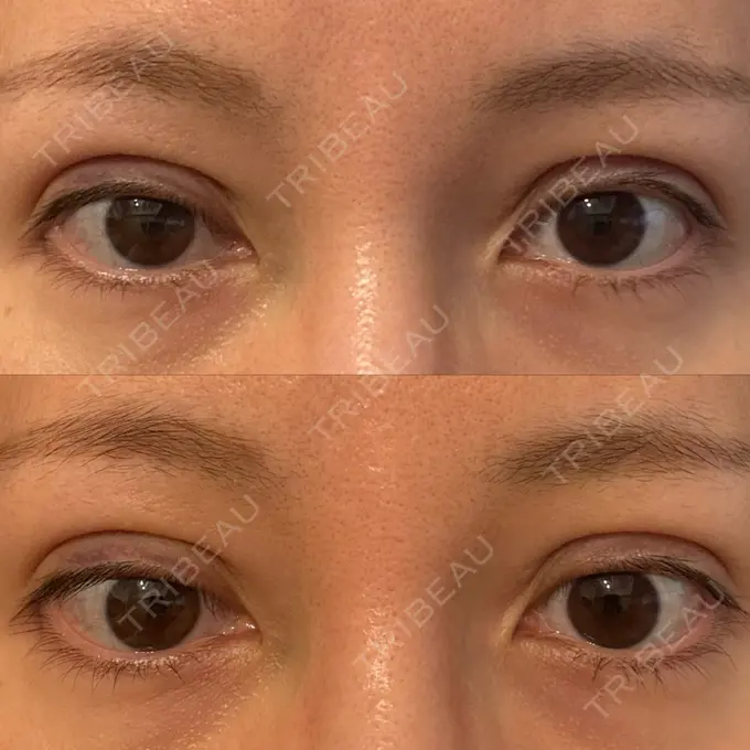 二重埋没 湘南美容クリニック 博多院 DAY 2 メイン用