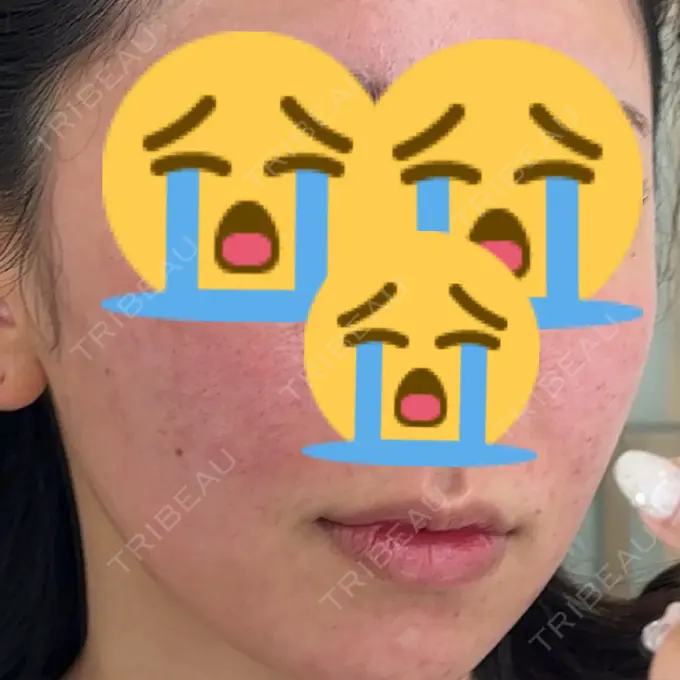 水光注射（ハリ・美肌） / 医療脱毛（顔） 栄美容クリニック 栄院 DAY 0 メイン用