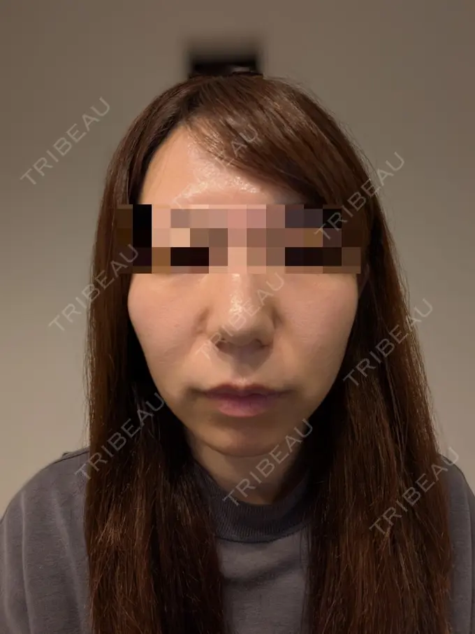 ピーリング（ニキビ・毛穴） Sea Sail Beauty Clinic DAY 0 メイン用