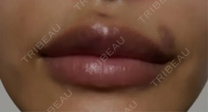 ヒアルロン酸注入（唇） 麻布十番クレールデンタルクリニック DAY 1 メイン用