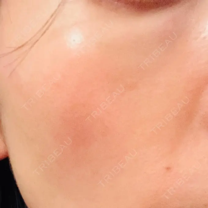 LDM・インテンスウルトラ 品川スキンクリニック広島院 DAY 3 メイン用